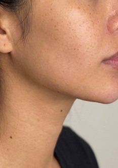 Defined jawline — after