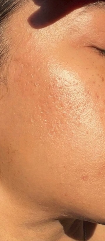 Smoother skin — before