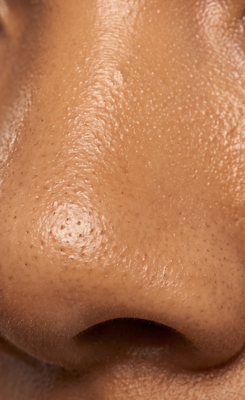 Clearer pores  — before