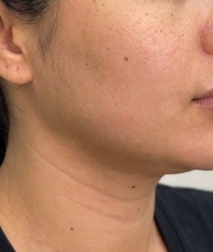 Defined jawline — before
